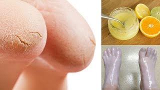 10 Simple Home Remedies For Cracked Heels [upl. by Letisha]