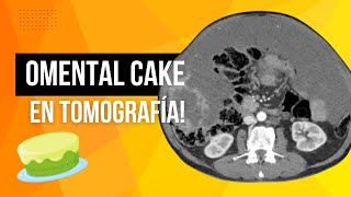 Omental Cake en TC Anatomía Hallazgos y Causas en 10 Min🔥✅ [upl. by Atena]