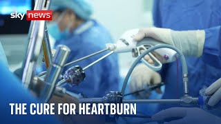 Heartburn Revolutionary surgical procedure cures condition with a device [upl. by Ahsats854]