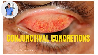 Conjunctival Concretions What are they Eye Dr Explains [upl. by Xylon]