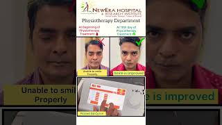 Physiotherapy results in Bells Palsy shorts [upl. by Eikcaj287]