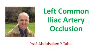 Left Common Iliac Artery Occlusion [upl. by Redvers37]