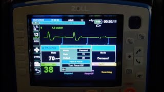 Zoll X Series Transcutaneous Pacing [upl. by Norah977]