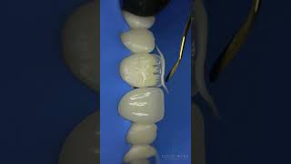 Anterior composite restoration shorts viral dentistry trending bds endodontics [upl. by Carine]