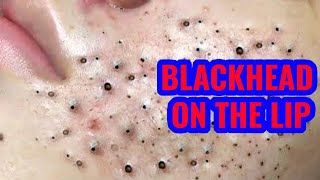 How To Treat a Blackhead On The Lip [upl. by Otto]