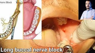 Local Anesthesia Long Buccal Nerve Block Technique Mandibular Anesthesia techniques dentistry [upl. by Simah]