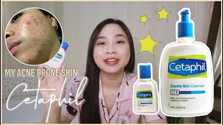 Buy This NOT That Drugstore Acne Cleansers  Part 1 by The Budget Dermatologist [upl. by Manbahs]