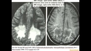 48 Xlinked Adrenoleukodystrophy XALD metabolic peroxisomal very long chain fatty acids VLCFA [upl. by Hach100]