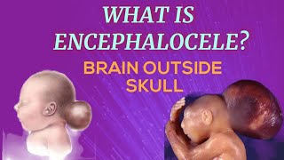 What is encephalocele [upl. by Lohrman]