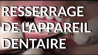 Resserrage de lappareil dentaire  Appareildentaireinfo [upl. by Kavita]