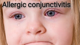 Allergic keratoconjunctivitis  Acute catarrhal keratoconjunctivitis Part 8 [upl. by Adnirolc]