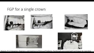 Fixed Partial Denture Part II Functionally generated path by Dr Rahul Jaiswal Guided by Dr Mahan [upl. by Llerrud103]