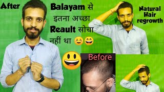 Balayam से इतना अच्छा Result सोचा नहीं था ☺️😄Balayam yoga Result  Hairline regrowth  Hairloss [upl. by Leksehcey907]