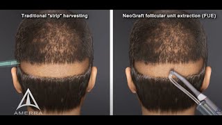 NeoGraft hair transplant procedure  animation [upl. by Nored]