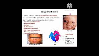 Congenital rubella syndrome [upl. by Noloc49]