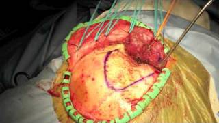 Neurosurgery  Pterional Craniotomy [upl. by Nayr]