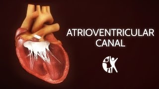 Atrioventricular Septal Defect  AV Canal [upl. by Orapma266]