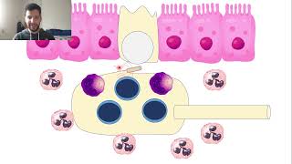 38Salmonelle non typhoide gastroentérite [upl. by Munshi]