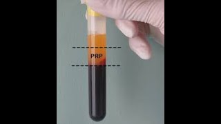 GEL PIASTRINICO  PRP PLASMA RICCO DI PIASTRINE [upl. by Doowyah]