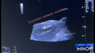 embryotransfer Blastocyst transfer embryo ivf icsi blastocyst endometrium infertility [upl. by Nadean]