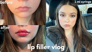 getting lip filler for the first time healing process before amp after results after 3 months [upl. by Vincenz]