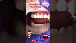 Colmillos de vampiro 🧛‍♂️ realizados por un Dentista 🦷 😷 shorts colmillos vampire vampiro [upl. by Kain]