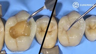 Step by Step Dental Filling Cavity Filling  Tooth Filling Cusp BuildUp of a Molar [upl. by Aihsad]