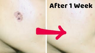 Face Dark Spots Treatment 100 Natural with 1 Vegetable Every Home Has [upl. by Notyal144]