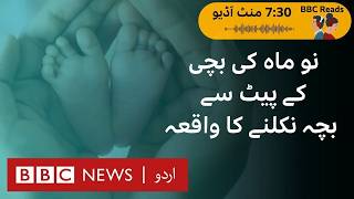 Babies born with another ‘baby’ inside their body  BBC URDU [upl. by Ayaet]