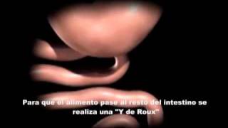 Bypass gastrico laparoscopico 2wmv [upl. by Veradis728]