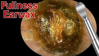 BIGGEST Ear Wax Difficult Removal  EP3  Doctor Anh [upl. by Duffy]