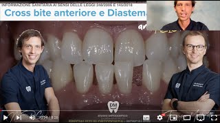 Ortodonzia con allineatori trasparenti Terza Classe Dentale prima dopo mascherine spazi tra i denti [upl. by Naffets798]