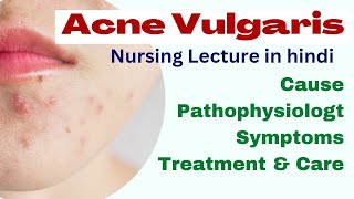 acne vulgaris lecture  msn  nursing lecture in hindi  cause symptoms treatment pathophysiology [upl. by Eetsim654]