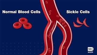 UCSF Berkeley UCLA to Launch Sickle Cell Trial Using CRISPR [upl. by Asilrac]