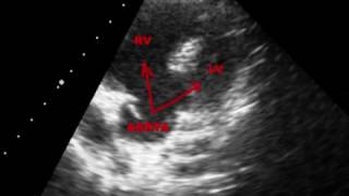 TETRALOGY OF FALLOT TOF  ECHOCARDIOGRAPHY SERIES BY DR ANKUR K CHAUDHARI [upl. by Hodgson]