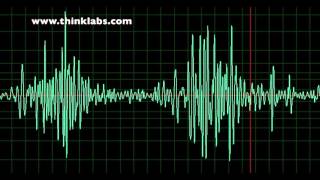 Patent Ductus Arteriosus slow [upl. by Alage]