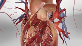 Pulmonary Artery Catheterization 3D Animation [upl. by Zulema]