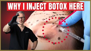 How To Inject Botox Under The Brow  Botox Brow Lift Advice [upl. by Comras]