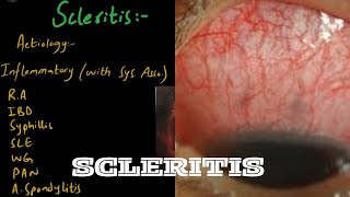 SCLERITIS in easiest way  Part 1 [upl. by Rothenberg487]