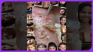 Satisfying Blackhead Removal Popping Pimples and Blackheads on Skin  2024 [upl. by Tebzil]