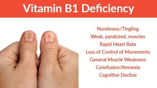 Thiamine Vit B1 Thiamine Vit B1Deficiency  Signs  Symptoms amp Treatment [upl. by Adnil]