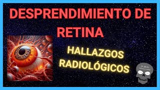 DESPRENDIMIENTO DE RETINA Hallazgos Radiológicos 👁️ [upl. by Yankee192]