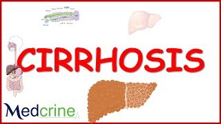 LIVER CIRRHOSIS causespathophysiologyfeaturesdiagnosistreatment [upl. by Ikim]