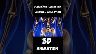 Concierge Catheter Medical 3D Animation short version [upl. by Nnayd]