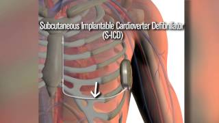 New SICD defibrillator a safety net for cardiac patients [upl. by Kapeed]