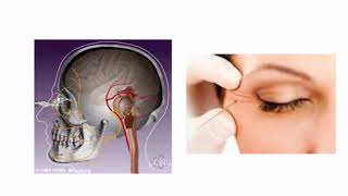 Hemifacial Spasm with Dr Dong Kim [upl. by Ahsien]