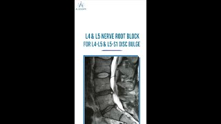 Nerve Root Block  Non Surgical Treatment for Back Pain [upl. by Atil]