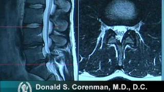 How to Read a MRI of a Lumbar Herniated Disc  Lower Back Pain  Colorado Spine Surgeon [upl. by Einial34]