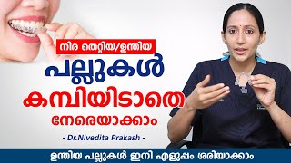 ഉന്തിയ പല്ലുകൾ ഇനി എളുപ്പം നേരയാകാം കമ്പിയിടാതെ  Clear Aligners for Teeth  Elite Dental Studio [upl. by Martino841]