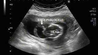 Ultrasound Video showing encephalocele [upl. by Eemia605]